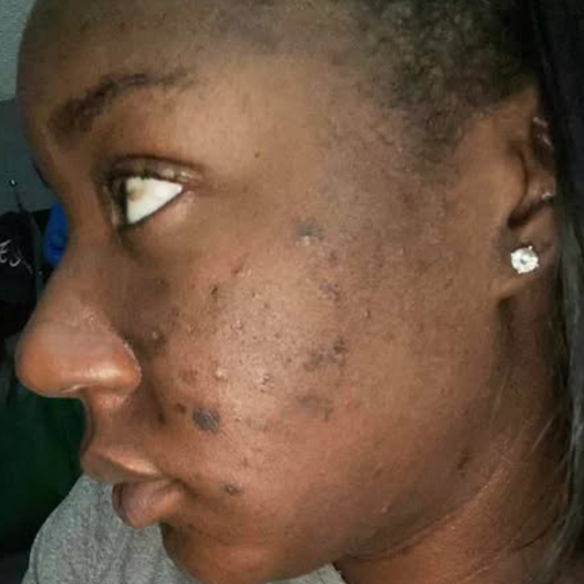 After using Nola's Anti-acne & Darkspot Face Oil