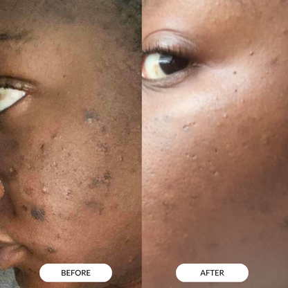 Nola's Anti-acne & Darkspot Face Oil