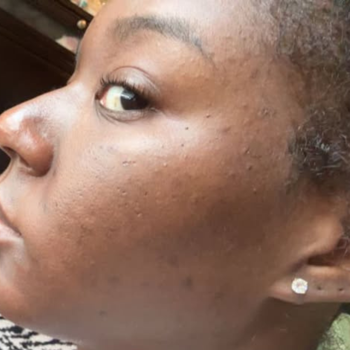 Before using Nola's Anti-acne & Darkspot Face Oil