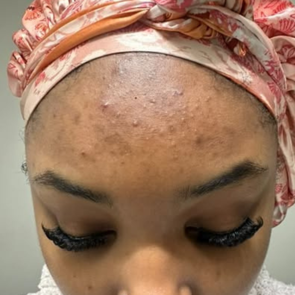 Before - Refreshen Lavender Toner