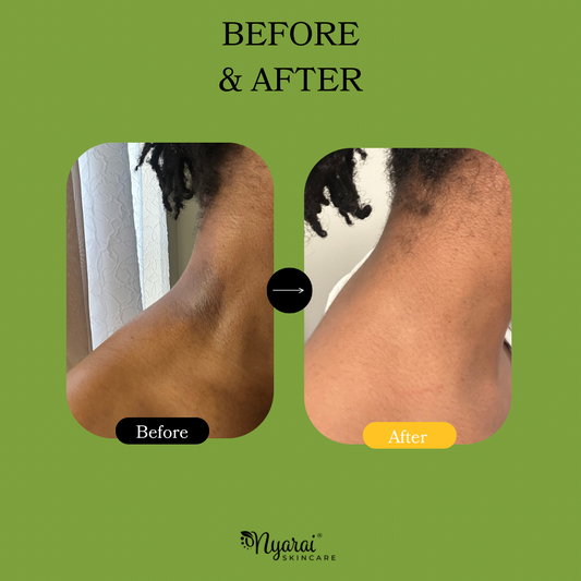 Body acne transformation - clear skin results from darkspot treatment kit